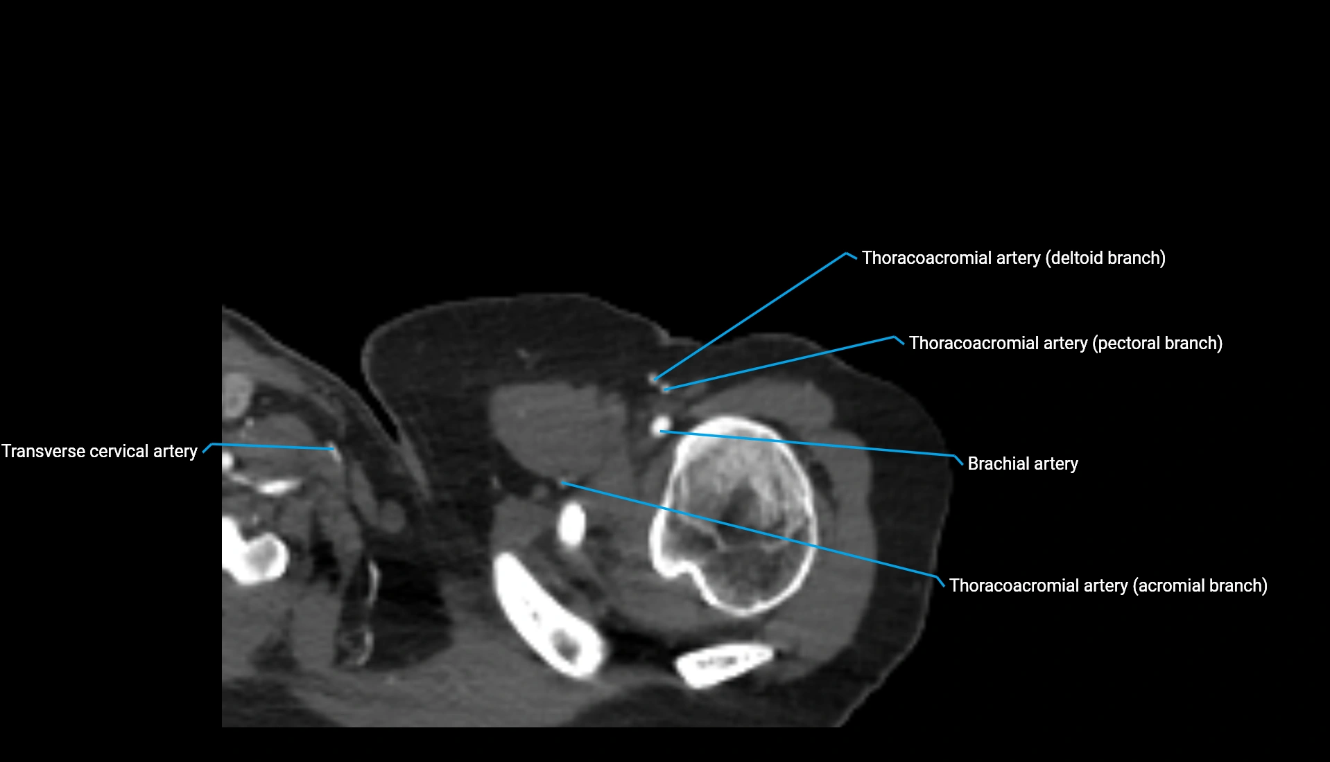 CTA upper limb axial cross sectional anatomy labelled image 321 (1).webp